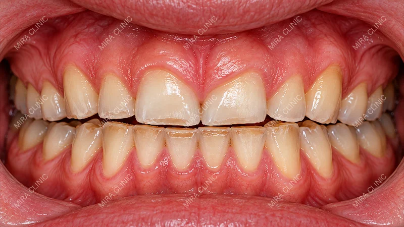 Bruxism or clenching